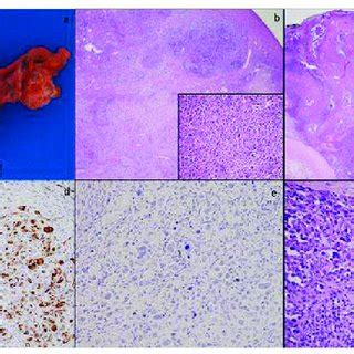 Total Abdominal Hysterectomy And Bilateral Salpingo Oophorectomy