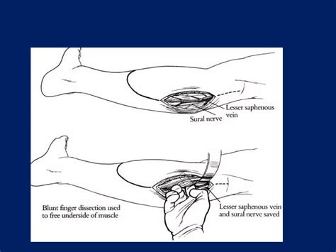 Gastrocnemius Flap PPT