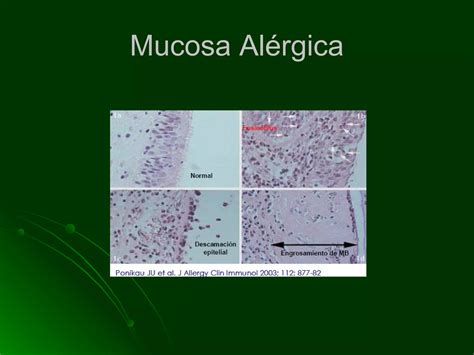 Cirugia Endoscopica En Poliposis Nasal Ppt