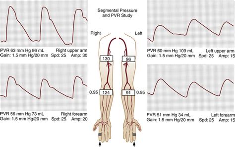 Assessment of Upper Extremity Arterial Occlusive Disease | Radiology Key