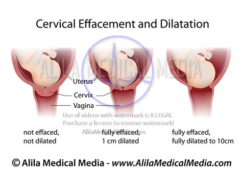 Alila Medical Media Cervical Effacement And Dilatation Medical