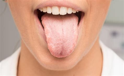 Leukoplakia Causes And Treatment