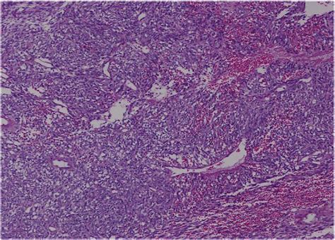 Photomicrograph Of The Histopathology Of Computed Tomography Guided