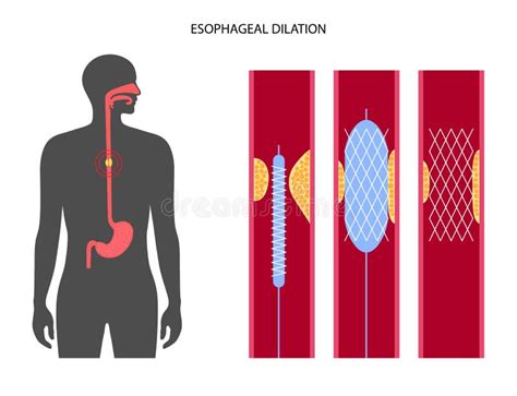 Esophageal Dilation Procedure