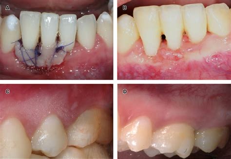 Técnica de injerto gingival libre mínimamente invasivo previo a