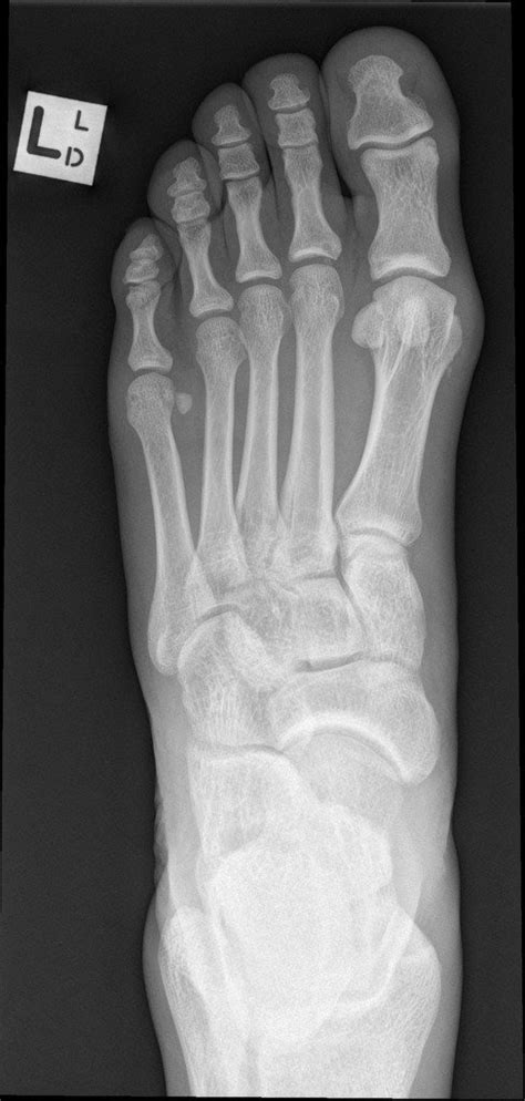 normal foot buyxraysonline