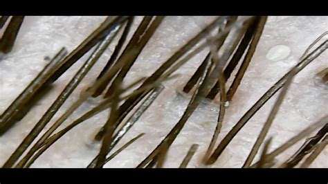 Long and short hair under a microscope (длинные и короткие волосы под ...