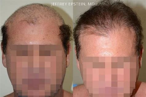 Hair Transplants For Men Photos Miami Fl Patient40134