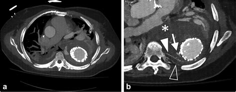 Direct Percutaneous Intercostal Artery Access For Thoracic Type Ii