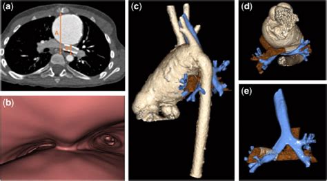 Preoperative Computed Tomography Axial Contrast Enhanced Computed