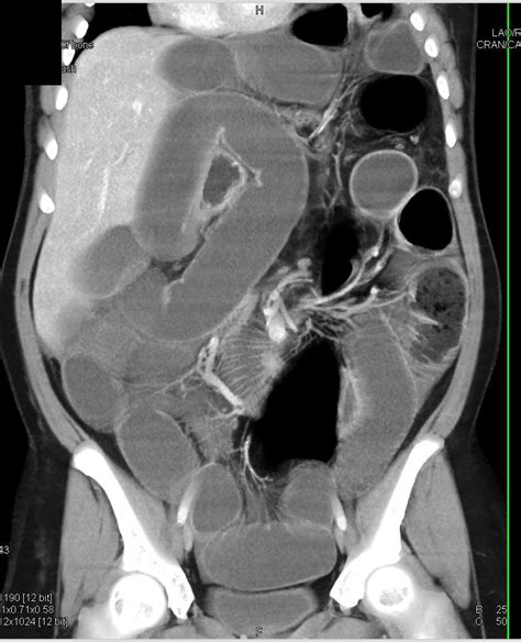 Small Bowel Obstruction Sbo Due To Adhesions Small Bowel Case