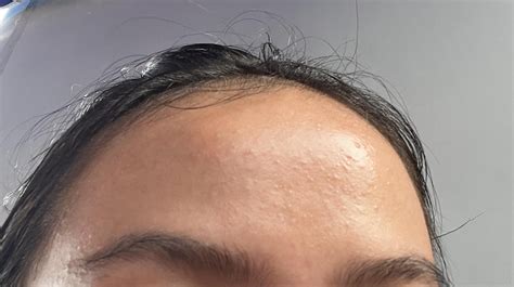 Any Ideas How To Get Rid Of Forehead Texturebumps Rskincareaddicts