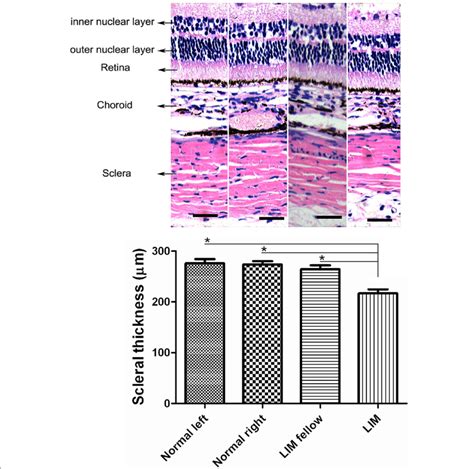 Alterations Of The Thickness Of Posterior Sclera In Normal Control And