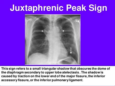 Radiological Signs In Chest Medicine Part 2