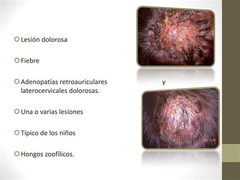 Dermatofitosis O Tiñas Ppt