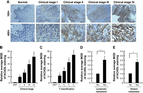 Ihc And Statistical Analysis Of Acadl Upregulation Pattern In Archived