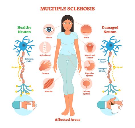 Understanding Multiple Sclerosis Brain Institute OHSU