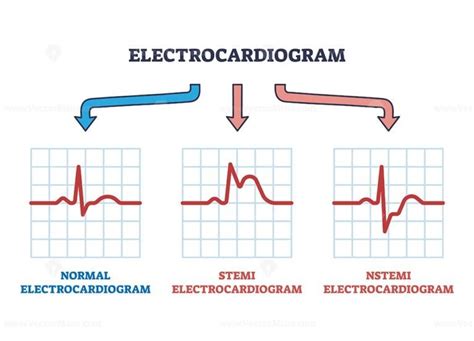 Electrocardiogram STEMI and NSTEMI abnormal heart rate outline diagram ...