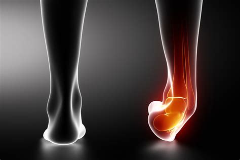 Sprained Ankle? Torn ankle ligaments, Ankle sprain - Physio Pretoria