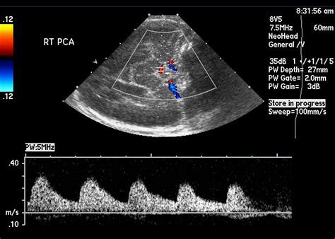 Normal Doppler Spectral Waveforms Of Major Pediatric Vessels Specific