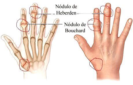 Nodulos En Las Articulaciones Mano Blog De Farmacia