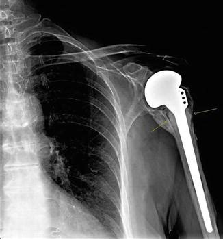 Complications of Treatment of Proximal Humerus Fractures ...