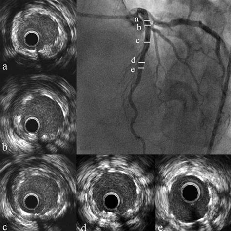 Intravascular Ultrasound IVUS Images Of Sirolimus Eluting Stent In