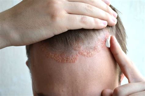 La Dermatitis Seborreica Y El Injerto Capilar ¿son Compatibles