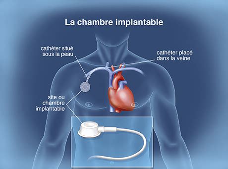 Chambre Implantable Cario