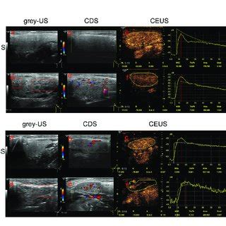 Multimodal Ultrasonographic Imaging Characteristics Of The Parotid