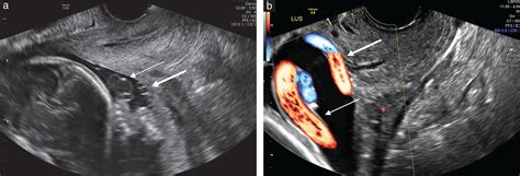 How To Screen For Vasa Previa Ranzini 2021 Ultrasound In Obstetrics And Gynecology Wiley