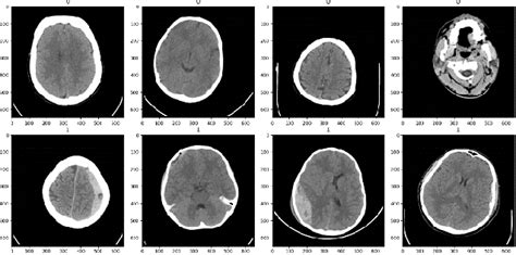 Figure 1 From Intracranial Haemorrhage Detection Based On Deep Learning