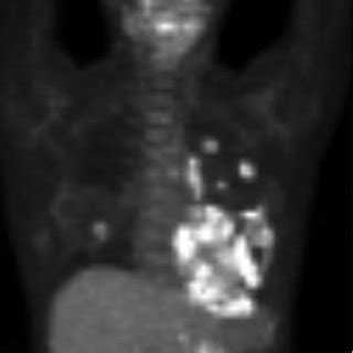 The Preoperative Chest Computed Tomography Ct The Ct Image Shows