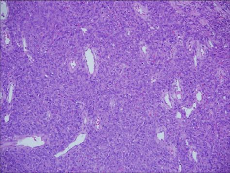 Proliferación de células fusiformes en patrón hemangiopericítico sin