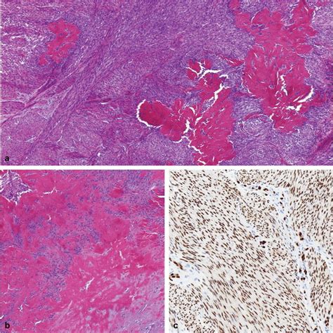 Kinase Rearranged Fibroblastic Tumors A B Bland Hypocellular Tumors