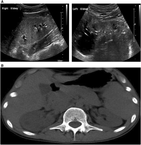 A Renal Ultrasound Reveals Echogenic Parenchyma With Numerous Small