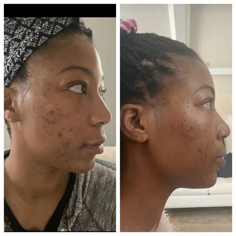 Pih Before After 3 Months On Tret Tretinoin