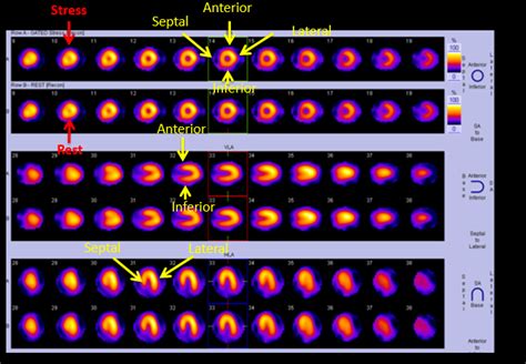 Nuclear Medicine Spect Scan Cardiovascular Assessment Protocols And