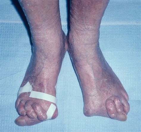 Collection 92 Pictures Photos Of Arthritis In Feet Full Hd 2k 4k