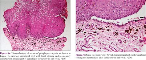 Clinical And Pathological Characterization Of Oral Mucosal Lichen