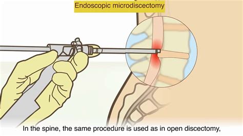 Disc Extrusion Treatment Options - Quotes Trending