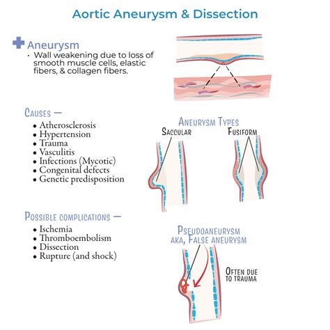 Clinical Pathology Glossary Aortic Aneurysm And Dissection Ditki Medical And Biological Sciences