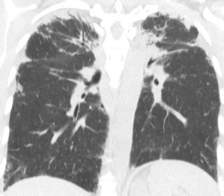 Diffuse Lung Diseases - Clinical Tree