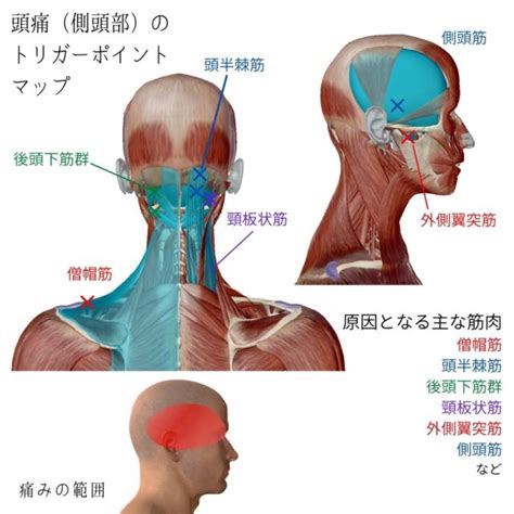 頭痛のツボ・トリガーポイントと原因となる筋肉