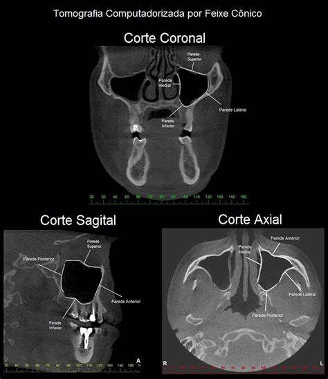 Os Seios Maxilares e sua relevância para o Cirurgião Dentista Papaiz