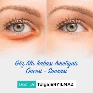 Göz Altı Torbası Ameliyatı Ankara Doç Dr Tolga Eryılmaz