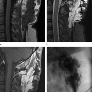 Macrocystic Lymphatic Malformation In A Month Old Infant With A