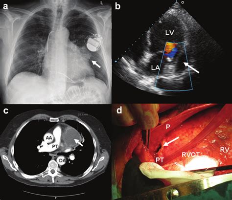 A Chest X Ray Showing Old Pericardial Calcifications And A New Oval