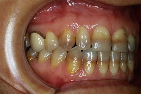 Casos Cl Nicos Antes Y Despu S Implantes Dentales Valencia