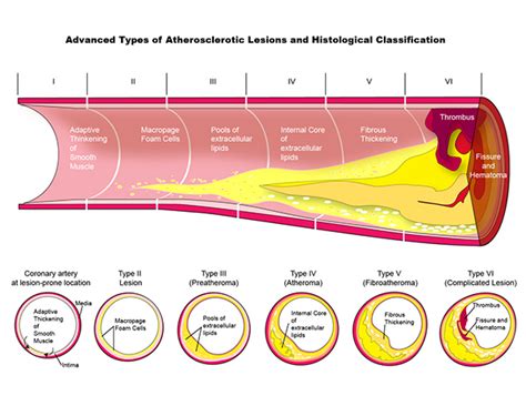 Advanced Atherosclerotic Lesions And Classifications On Behance